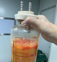 衡阳水动力吸脂手术要做多久？